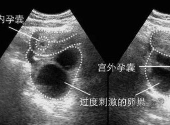 重度宫腔粘连在子长市做试管婴儿靠谱吗，重度宫腔粘连试管婴儿成功率多少！